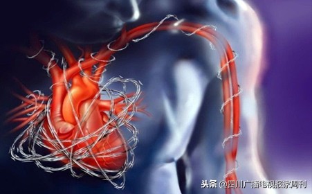 华西专家权威解读,通俗易懂的讲解什么是冠心病