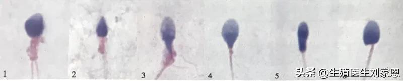 精子畸形率高有办法治吗,精子畸形率高是否容易生畸形儿