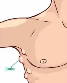 皮下脂肪瘤突然增大又会变小,长了脂肪瘤怎么办