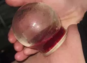 腰缠万贯到底是什么,腰缠万贯是什么病