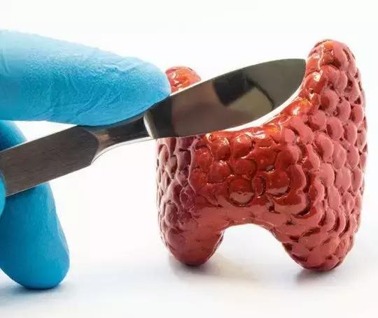 甲状腺结节ti-rads3类可以自愈吗,甲状腺结节ti-rads3类能自愈吗