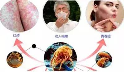 脸上长痘调理方法,血热脸上长痘该怎么调理