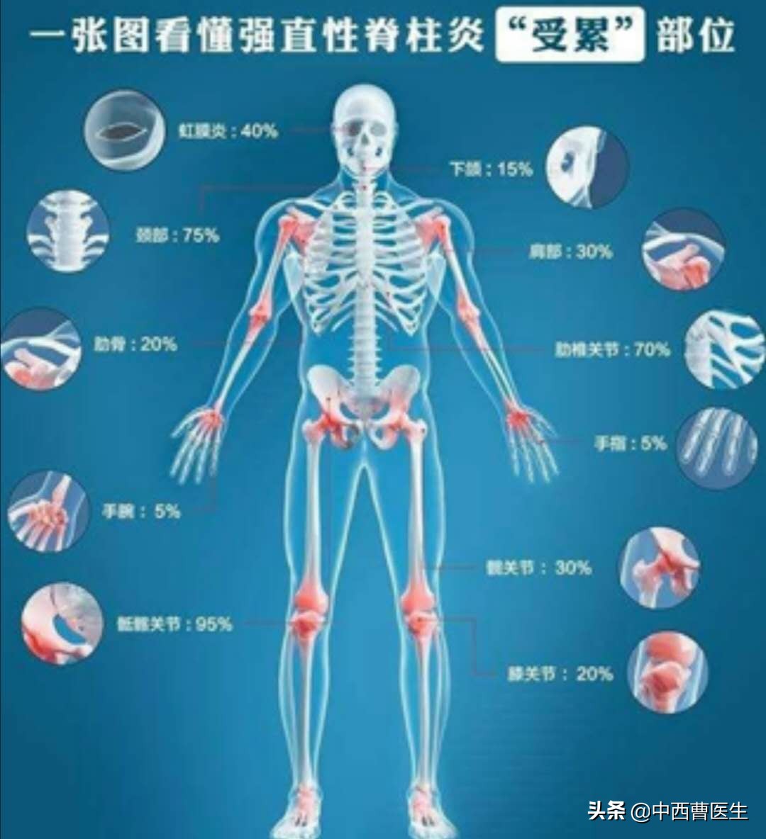 强直性脊柱炎的诊断和治疗,什么是强直性脊柱炎如何治疗