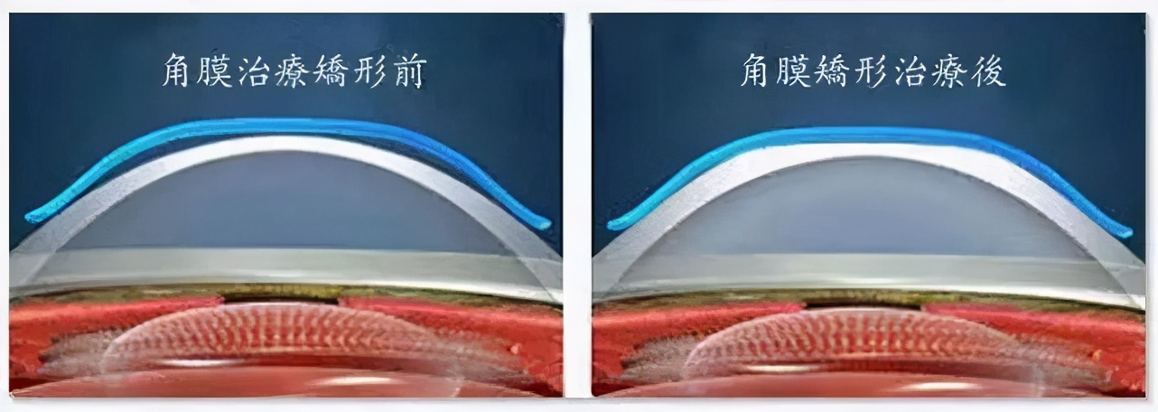 角膜塑形镜价格表和品牌,角膜塑形镜到底靠不靠谱
