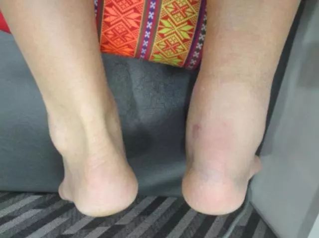 杜兰特和汤普森受伤视频,伤病猛于虎是什么意思