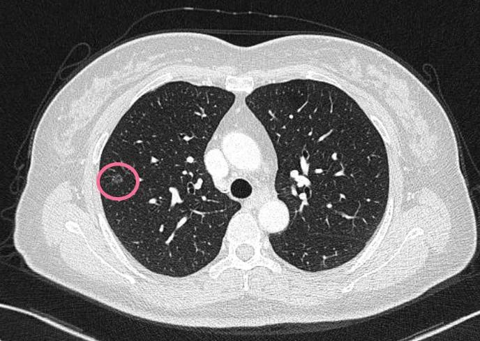 右肺下叶微小结节是什么意思,诊断报告左肺下微小结节没写大小
