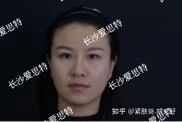 哪些人群不适合做热玛吉?