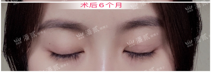 重度上睑下垂术后为什么闭不上眼睛？闭眼不全怎么护理好？