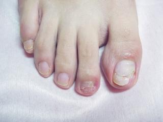 同事有灰指甲怎么预防传染,得了灰指甲怎么预防传染