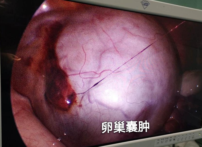 怀孕初期卵巢囊肿扭转怎么办,怀孕了查出来卵巢囊肿需要手术吗