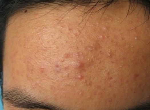 脸上痘痘反复长怎么办学生,教你脸上长痘怎么快速消除小妙招