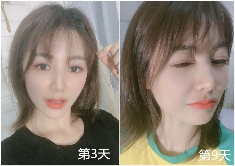 光子嫩肤540,480nm光子嫩肤