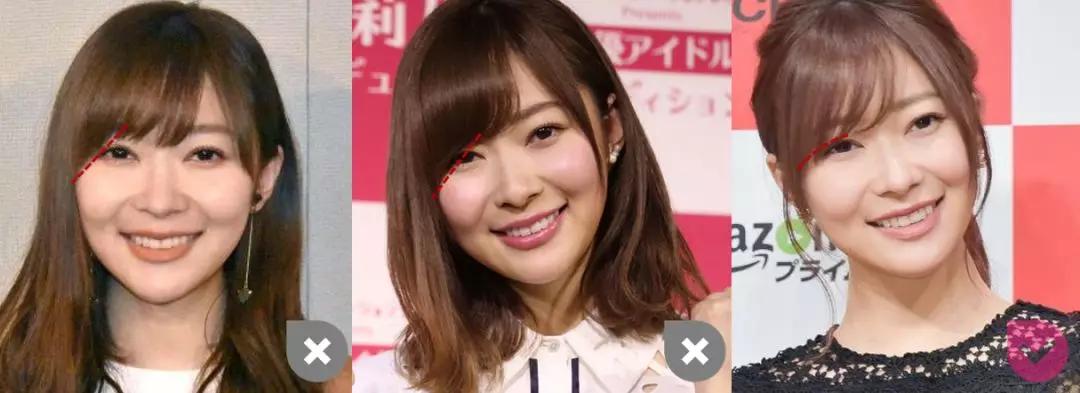 颧弓高脸型怎么改善,有泪沟可以通过调整脸型改善嘛