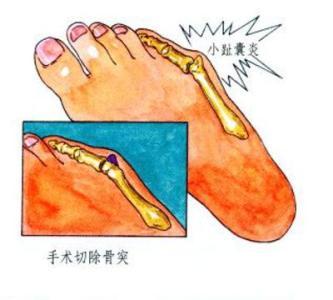 小脚趾滑囊炎警惕四种病,小脚趾拇囊炎怎么治疗