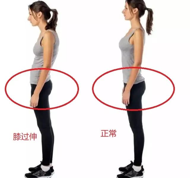 膝超伸腿粗运动可以改善吗,大粗腿膝超伸矫正方法图解