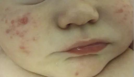 新生儿长痘痘会不会痒,新生儿都会长痤疮吗