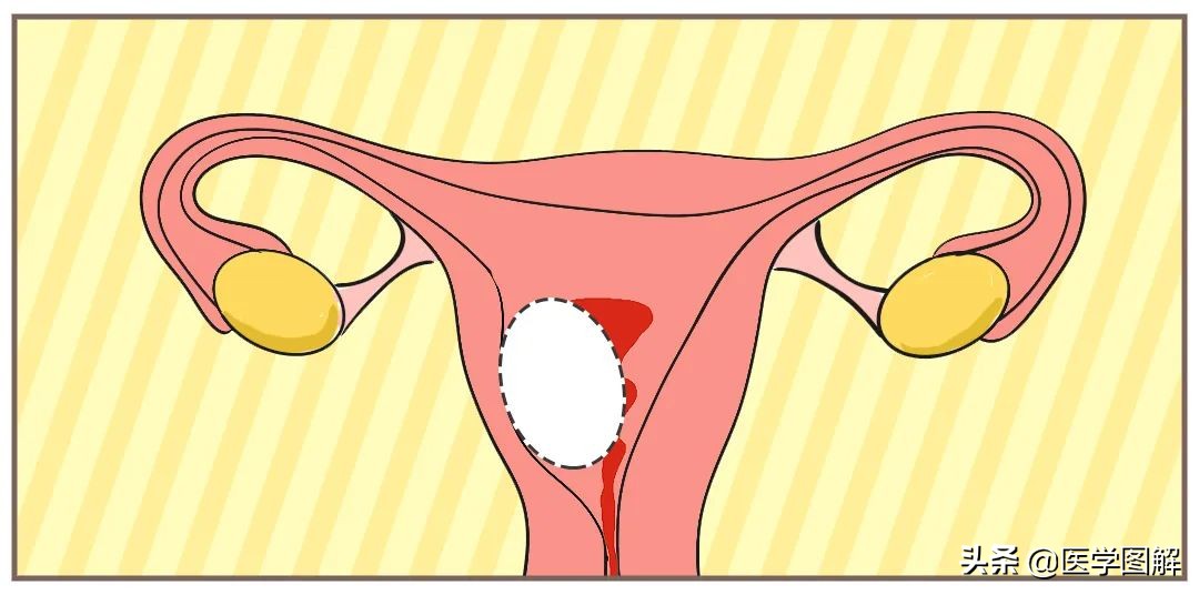 子宫肌瘤，比你想象的可怕！瞬间就危在旦夕？丨医学图解