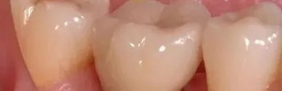 种植牙第一次拆线后的步骤,种植牙二期修复取模的步骤