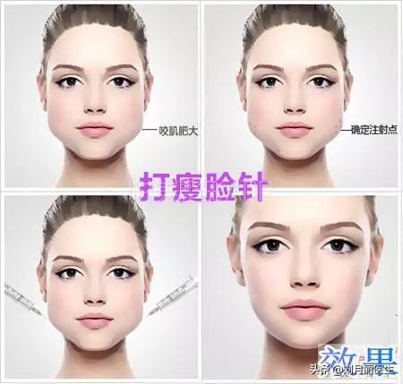瘦脸针的最全搭配专治各种不完美,想要脸小做什么医美项目