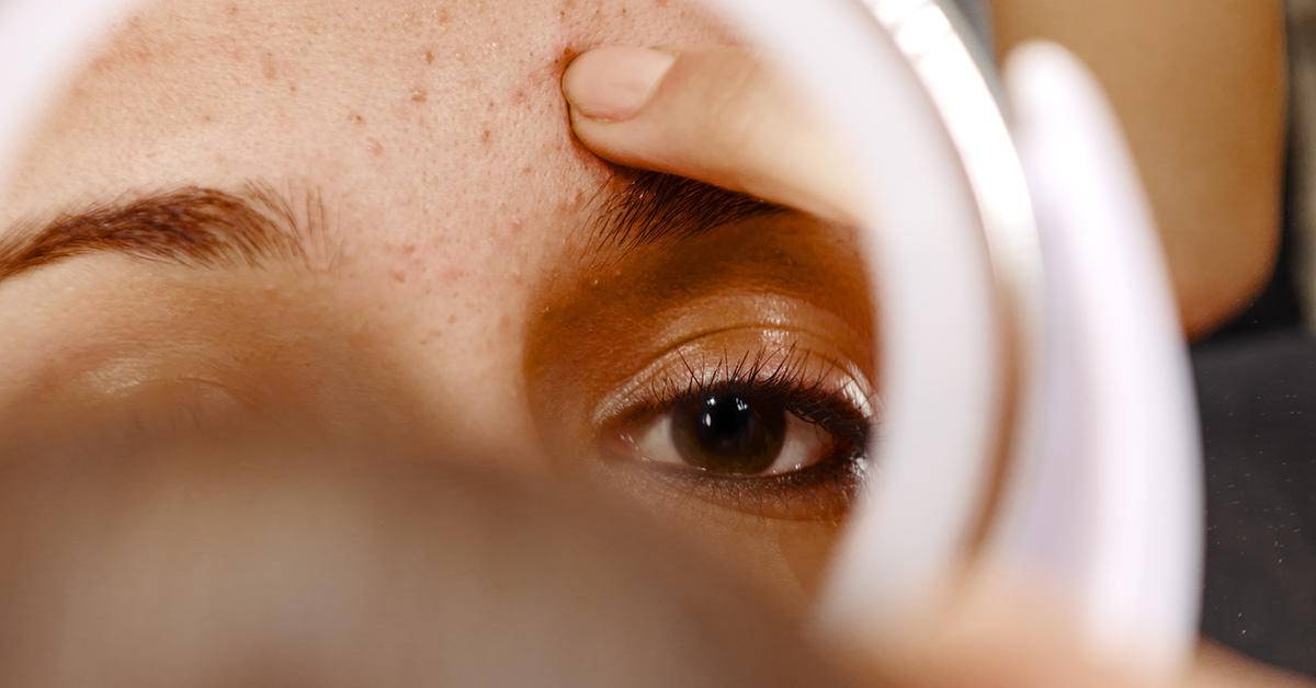 痘痘好多了脸一直红,痘痘反复没完没了