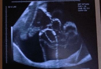 产检一路绿灯生下胎儿妈妈哭了,产检一路绿灯生下男婴却没有皮肤