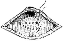 大猪脐疝怎么解决,猪脐疝防治方法