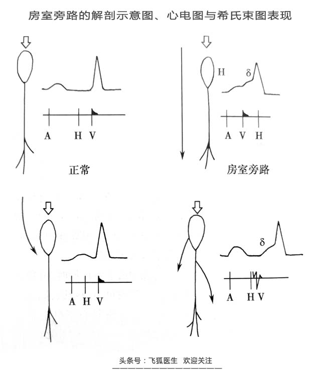 预激综合征是心脏的什么病,预激综合征什么引起的