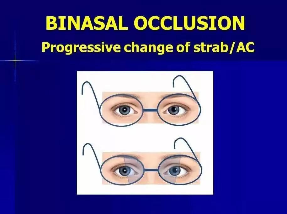 部分调节性内斜视矫正的最佳方法,部分调节性斜视是什么样子