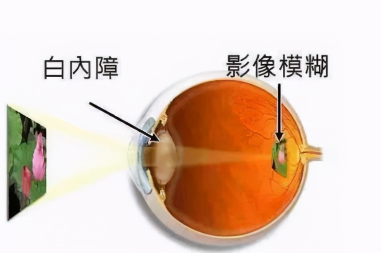 年轻人白内障是什么原因引起来的,年轻人也得白内障么