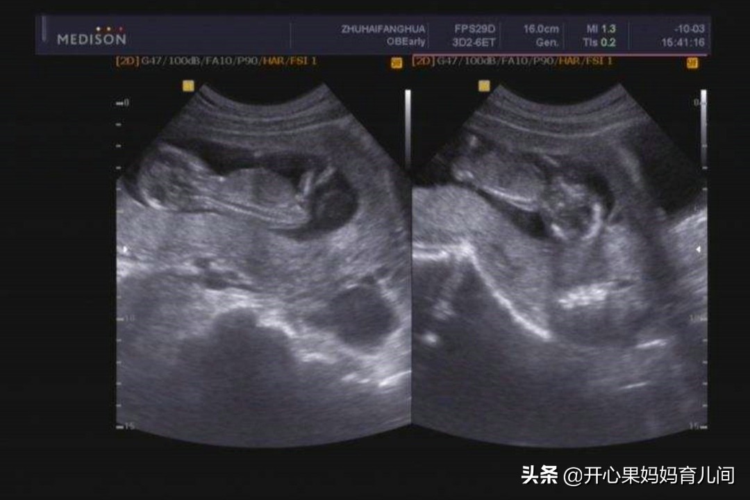 胎盘成熟度1-2级大概在多少周之内,17周胎盘1级属于胎盘早熟吗