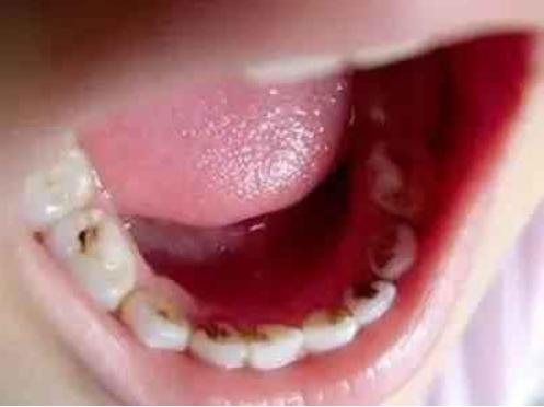 长期抽烟口臭是怎么来的,为什么吸烟的人口臭