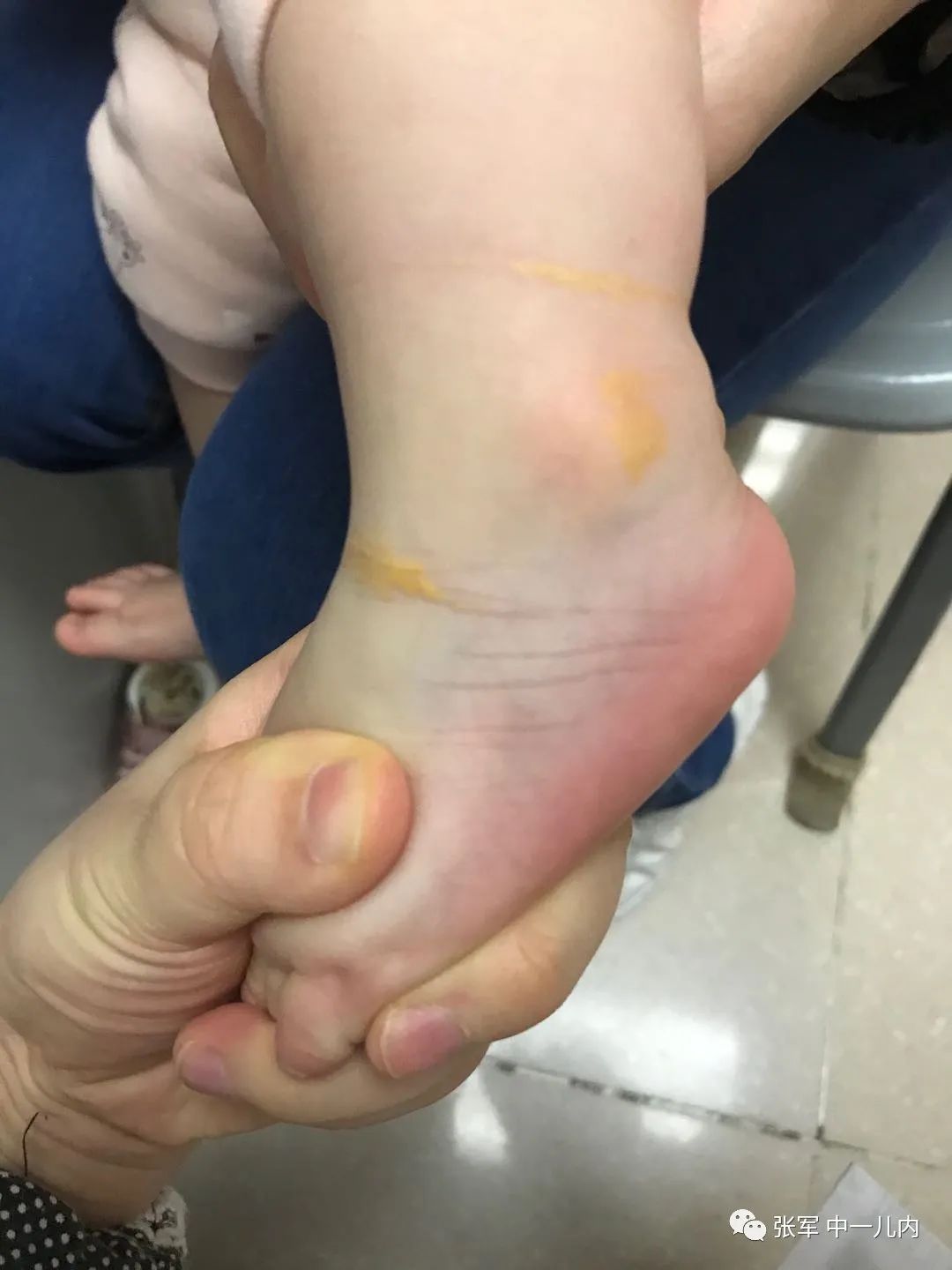 单纯乳房发育的，最后都是好结局吗？