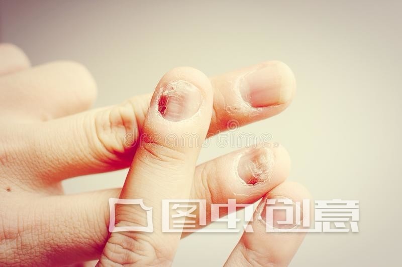 孩子咬手指甲抠指甲是什么原因,孩子咬指甲抠指甲