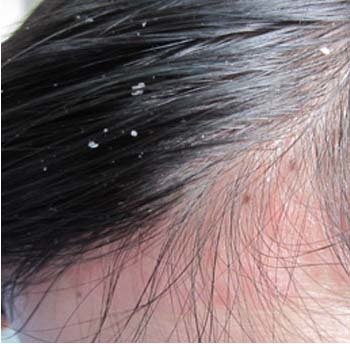 头屑和银屑病最明显的区别,头屑增多大块头屑是不是银屑病