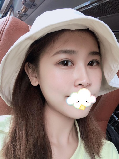 修志夫做双眼皮效果怎么样,修志夫双眼皮修复