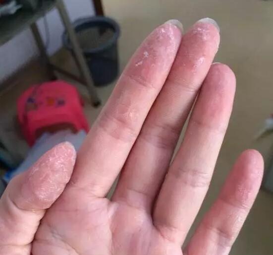 502胶水把手粘住了怎么办用什么,502胶水把手粘住了怎么办