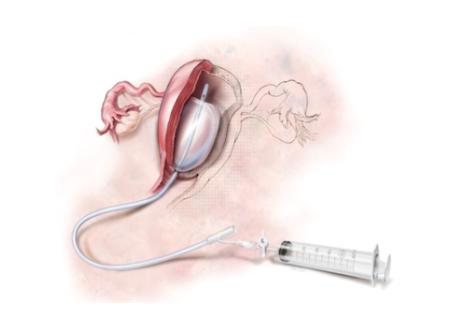产后大出血死亡率最高的杀手,产后出血护理疑难病例讨论