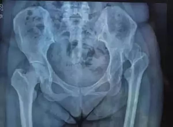 髋关节疼有哪几种原因,髋关节痛如何能确诊什么原因引起