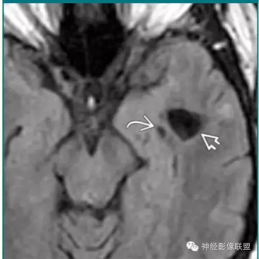 各种囊肿的症状,颅内囊肿18-19mm严重吗