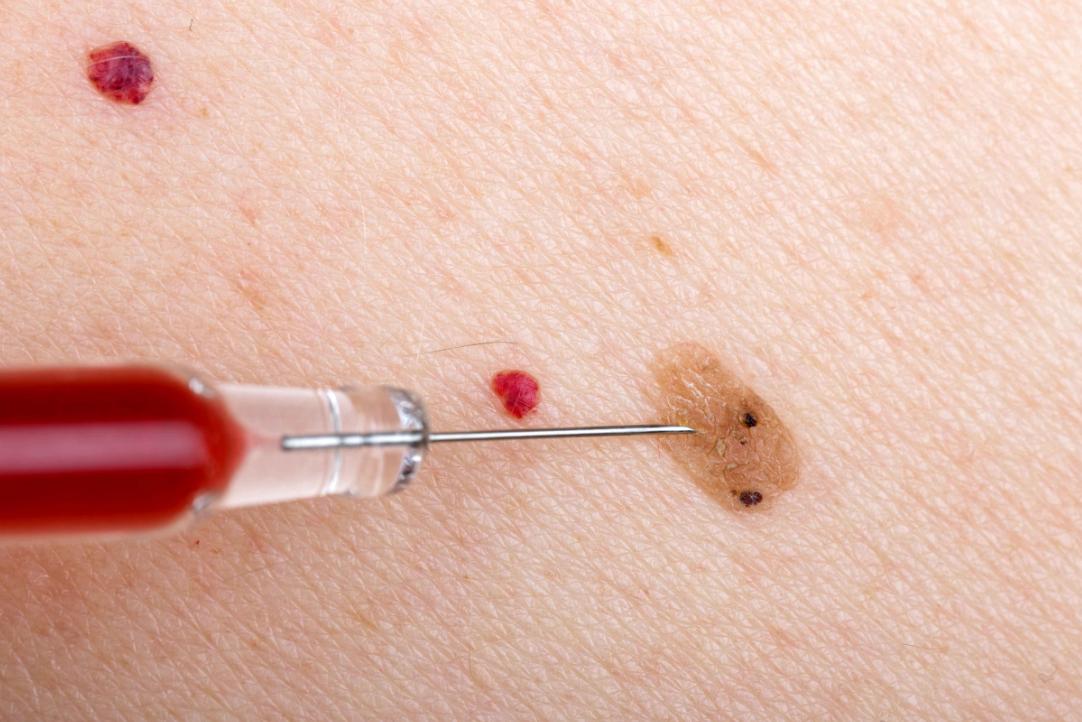 皮肤上长红痣要当心是肝病的征兆,有肝病前胸后背会出现小点红痣