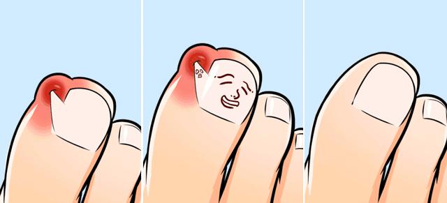 甲沟炎好痛怎么办,甲沟炎又疼又难受教你一招解决