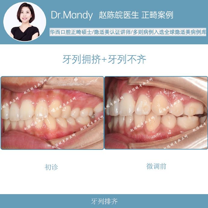 隐适美隐形矫正成功案例,经典隐形矫正