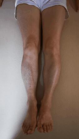 常见腿型矫正,长短腿矫正前矫正后对比