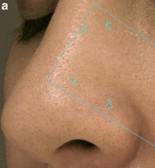 别折腾了，你这样去黑头是没有用的！