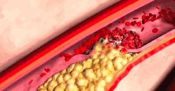 放支架后能打流感疫苗吗,支架术后可以打流感疫苗吗
