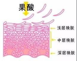 果酸换肤效果能持续多久,果酸换肤真能祛痘印吗