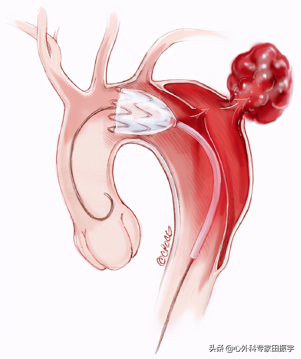主动脉夹层破裂b型,急性主动脉夹层动脉瘤破裂