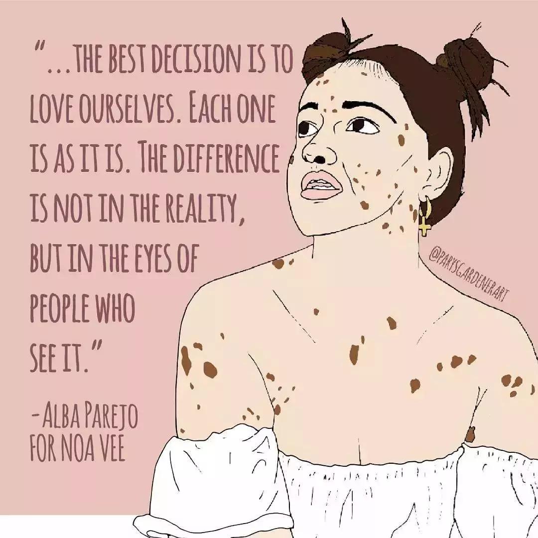 全身黑斑被骂“斑点狗”，身高160的她却成为最美超模…