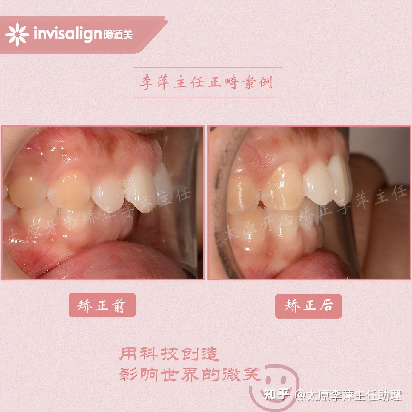 重度拥挤矫正牙齿适合隐形牙套吗,广州成人牙齿矫正推荐隐形牙套
