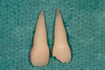 牙齿断了把牙根拔出,牙齿断了拿另一半能补吗